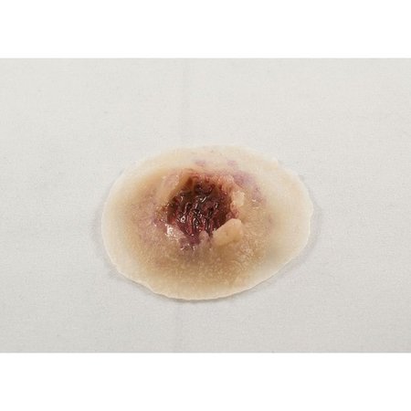 MOULAGE SCIENCE & TRAINING Gunshot Exit Wound, Light, PK 18 MST-02-02-18